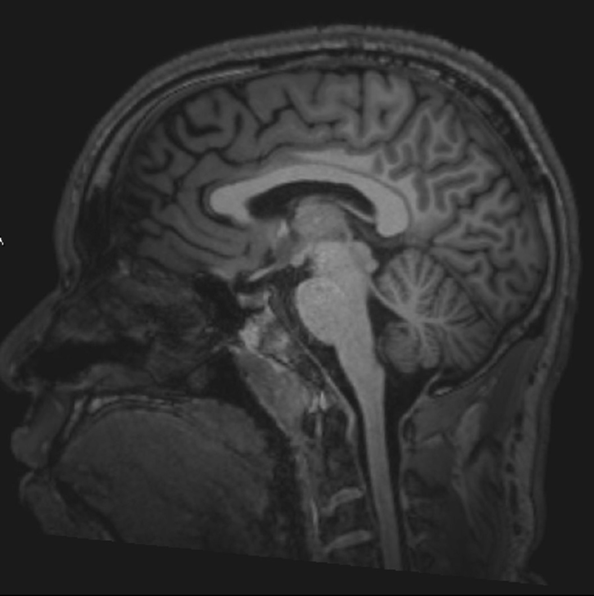Phim chụp MRI não bình thường (đứng dọc) – Lát cắt 3
