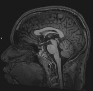 Normales MRT des Gehirns (sagittal) – Folie 4)