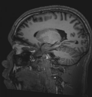 Normal Brain MRI (Sagittal) – Slide 5