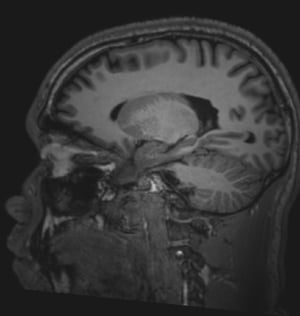 Phim chụp MRI não bình thường (đứng dọc) – Lát cắt 5