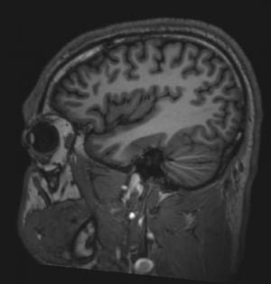 Normales MRT des Gehirns (sagittal) – Folie 6)