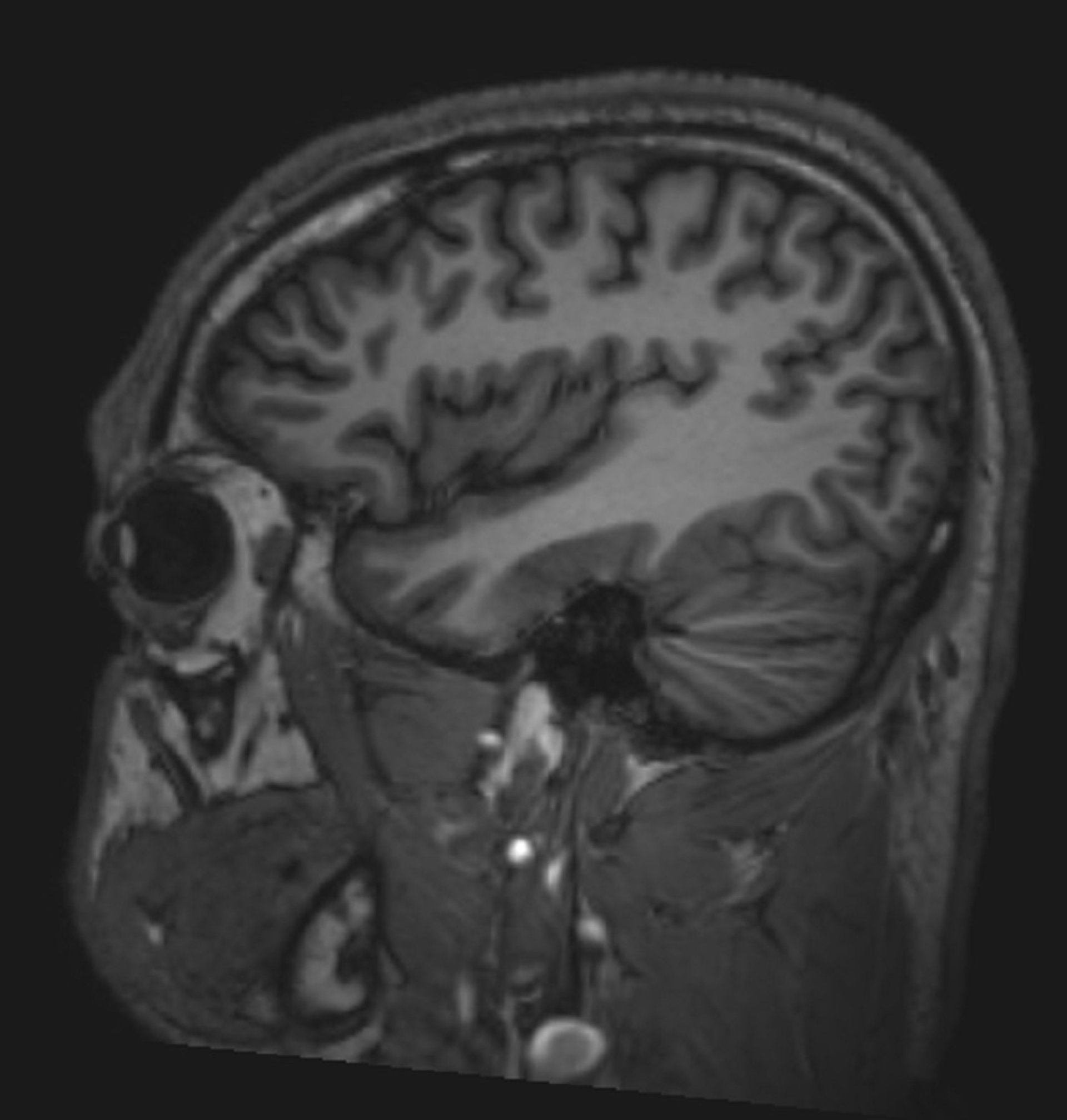 RM do cérebro normal (sagital) – Diapositivo 6