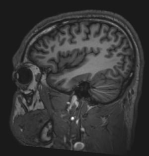 Phim chụp MRI não bình thường (đứng dọc) – Lát cắt 6