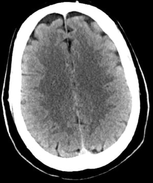 Normal Head CT Scan (Adult, Age 30) – Slide 2