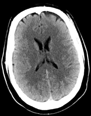 Chụp CT đầu bình thường (người lớn, 30 tuổi) – Lát cắt 4