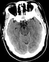Normal Head CT Scan (Adult, Age 30) – Slide 6