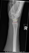 Normal Wrist: Lateral View