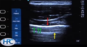 Línea pleural normal