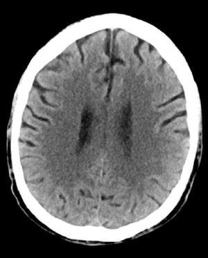 TC cerebrale normale (adulto di 74 anni), slide 3
