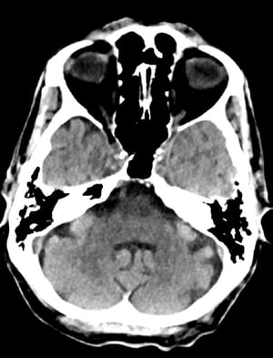 Chụp CT đầu bình thường (người lớn, 74 tuổi) – Lát cắt 8