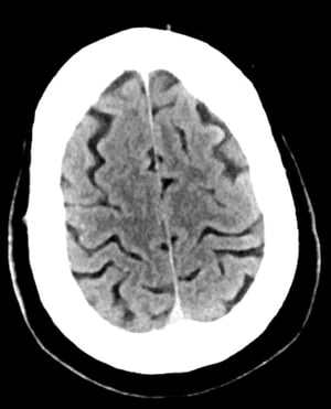 Tomografía computarizada craneal normal (adulto, 30 años)–diapositiva 1