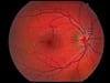 Retina normal