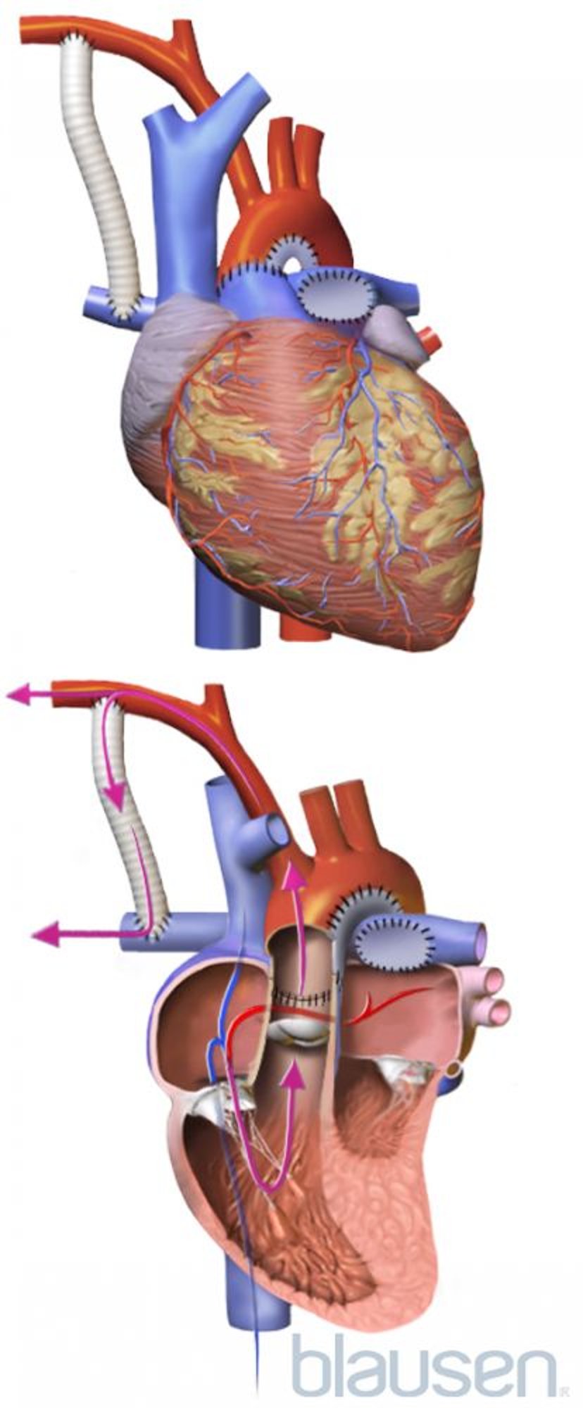 Procedura di Norwood