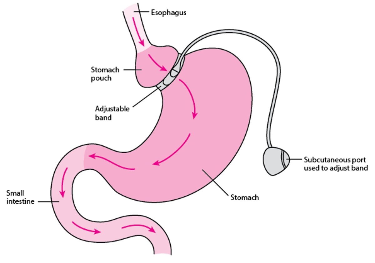 Adjustable Gastric Banding