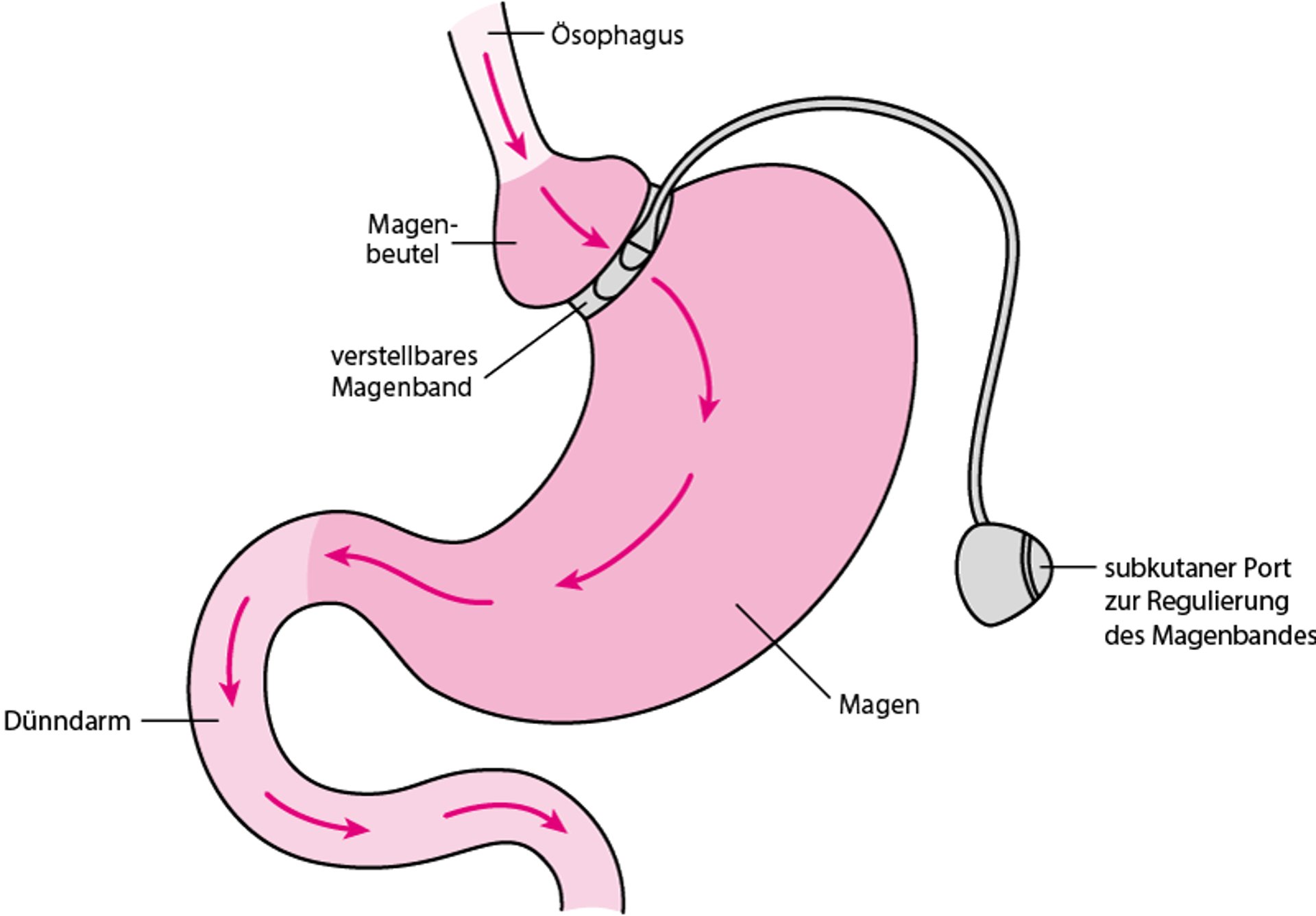 Verstellbares Magenband (Adjustable gastric banding)