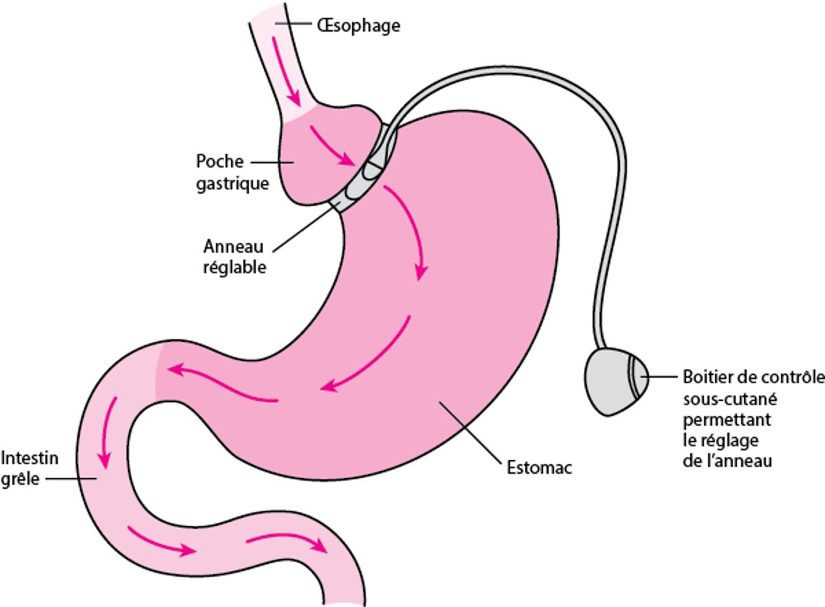Gastroplastie verticale calibrée