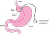 Bendaggio gastrico regolabile