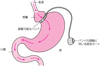 調節性胃バンディング術