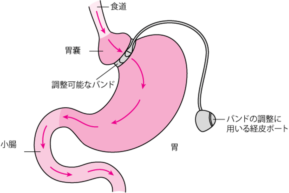 調節性胃バンディング術