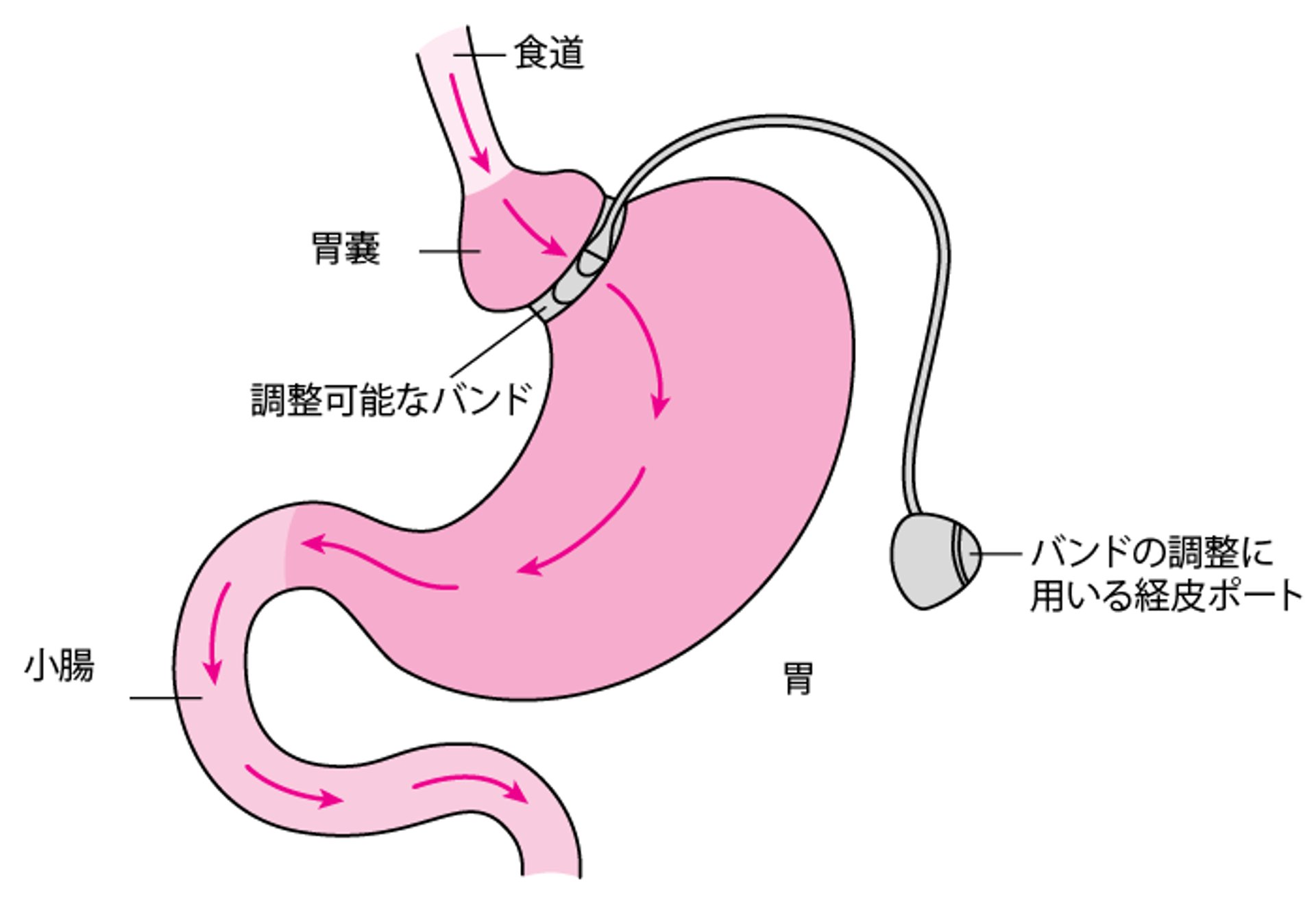 調節性胃バンディング術
