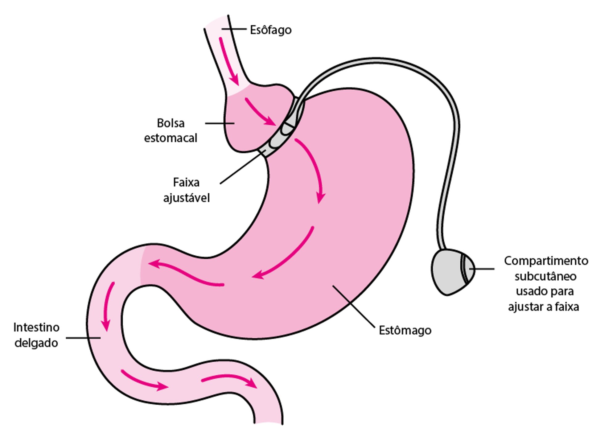 Banda gástrica ajustável