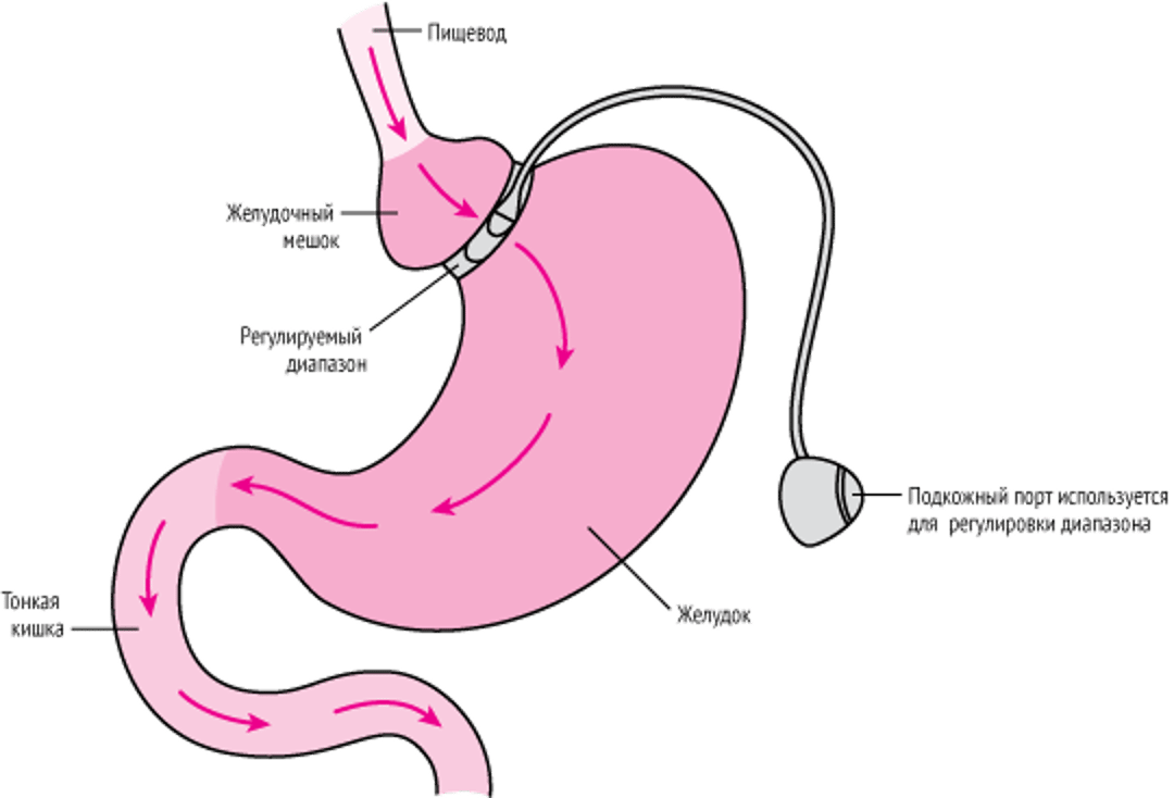 Регулируемое бандажирование желудка