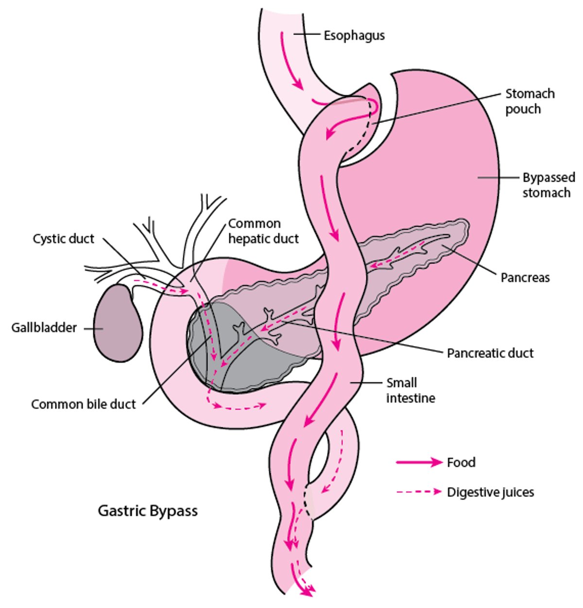 Roux-en-Y Gastric Bypass Surgery