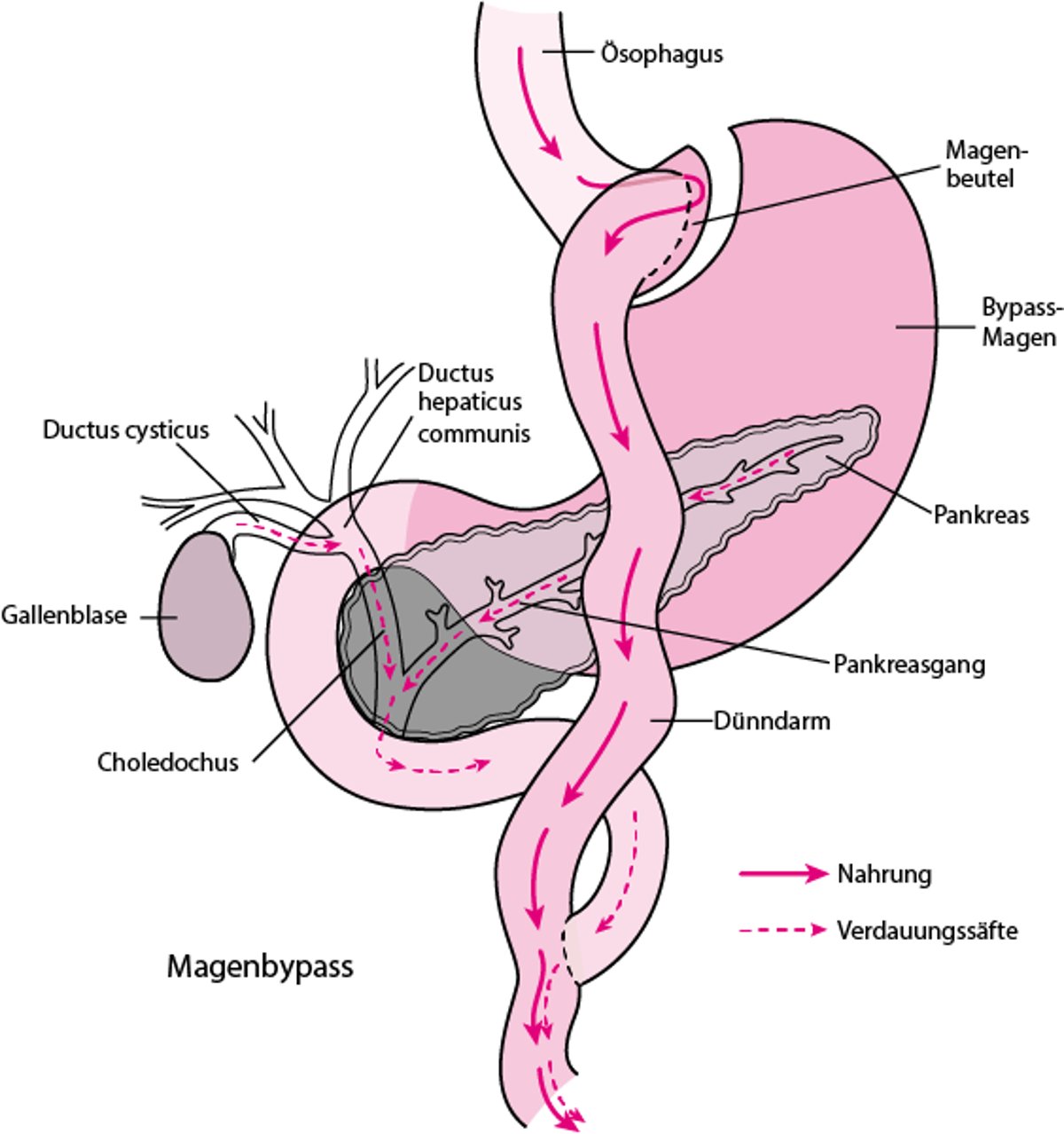 Roux-en-Y-Magenbypass-Operation