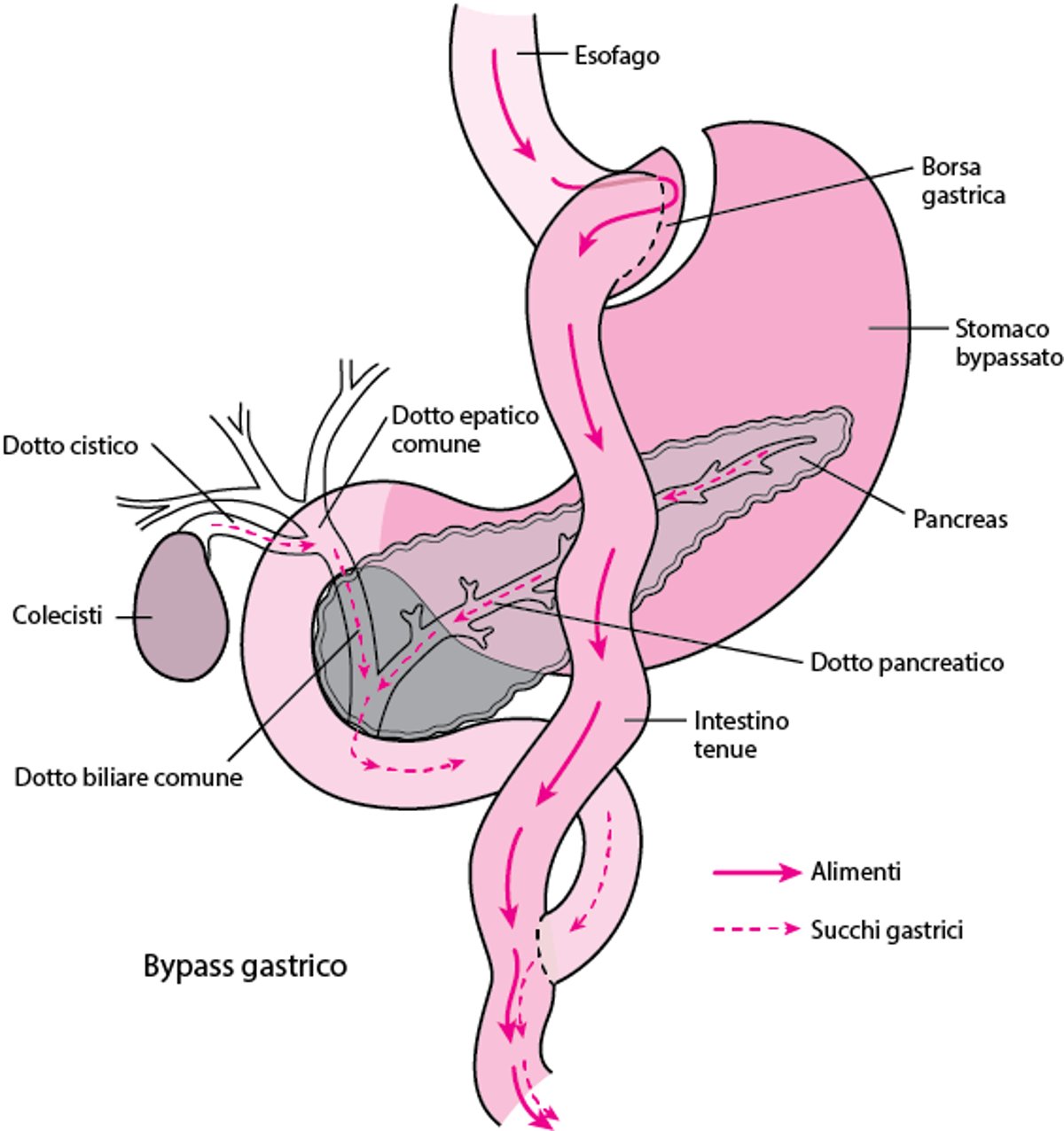 Chirurgia di bypass gastrico di Roux-en-Y