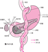 Roux-en-Y法による胃バイパス術