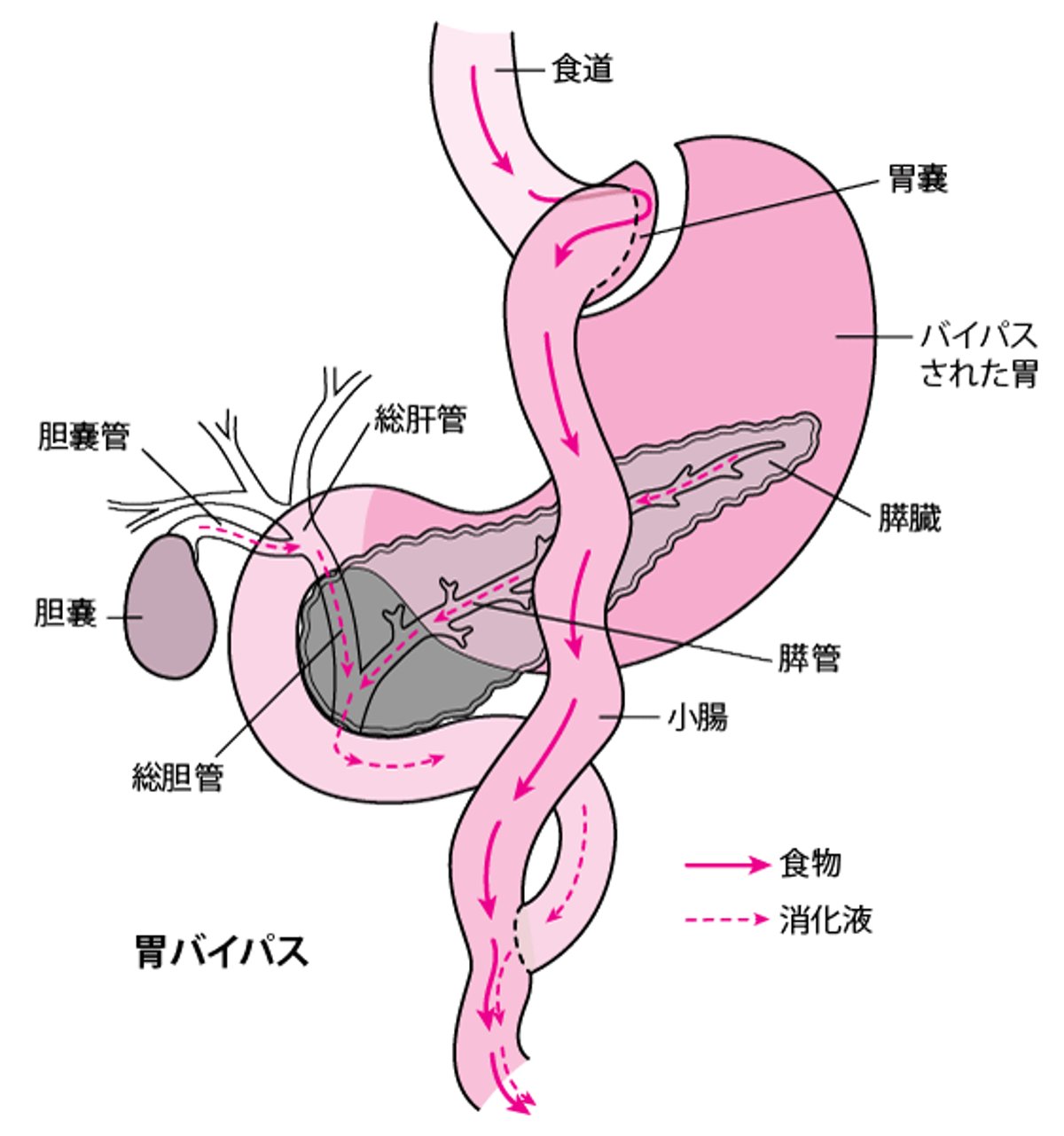 Roux-en-Y法による胃バイパス術