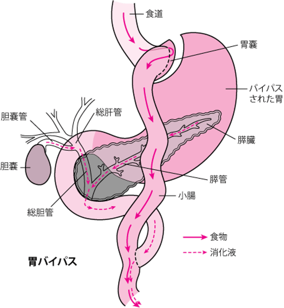 Roux-en-Y法による胃バイパス術