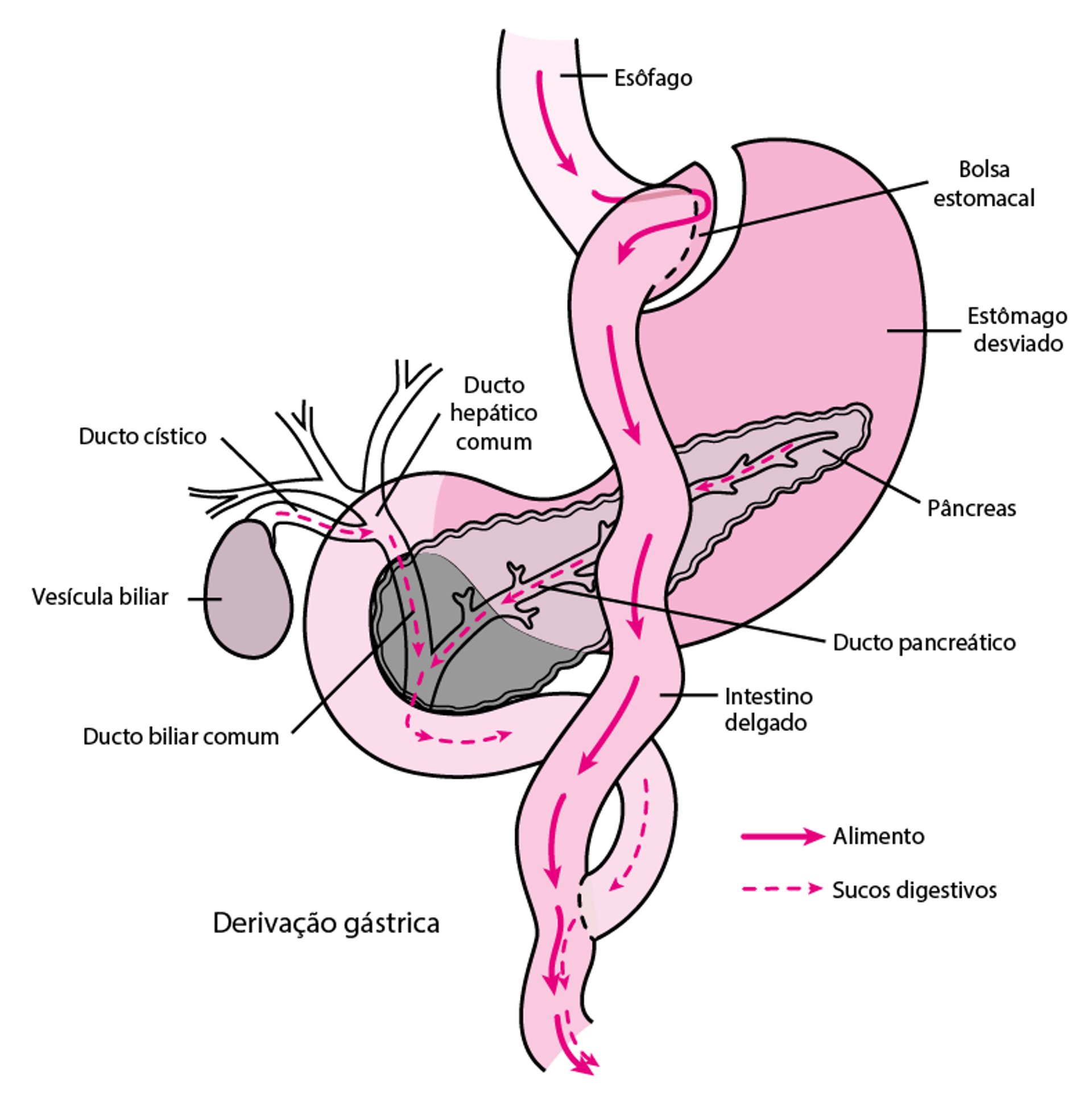 Cirurgia de bypass em Y de Roux