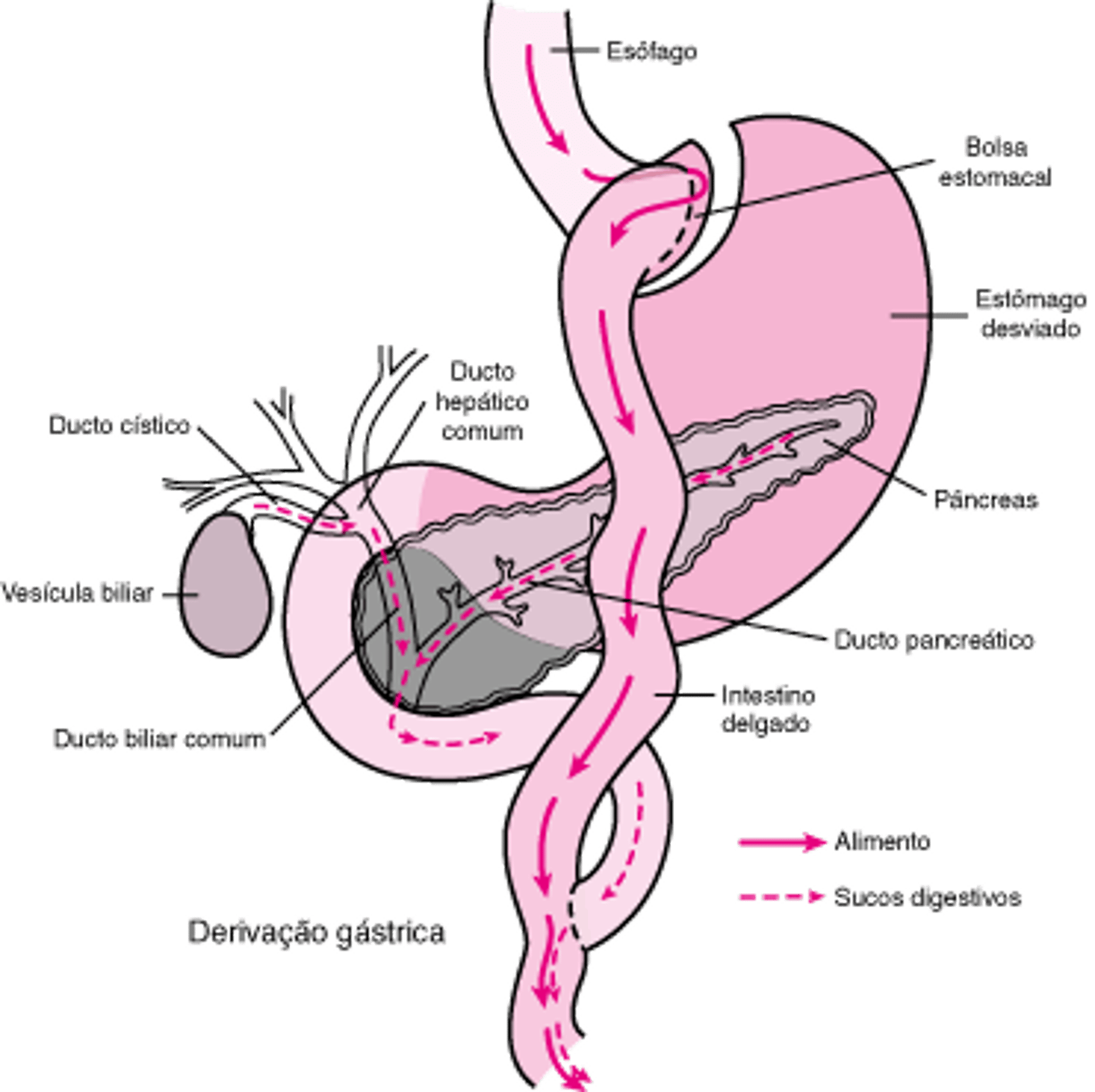 Cirurgia de bypass em Y de Roux