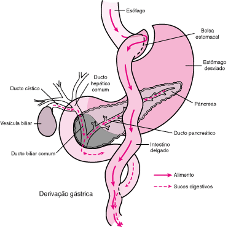 Cirurgia de bypass em Y de Roux