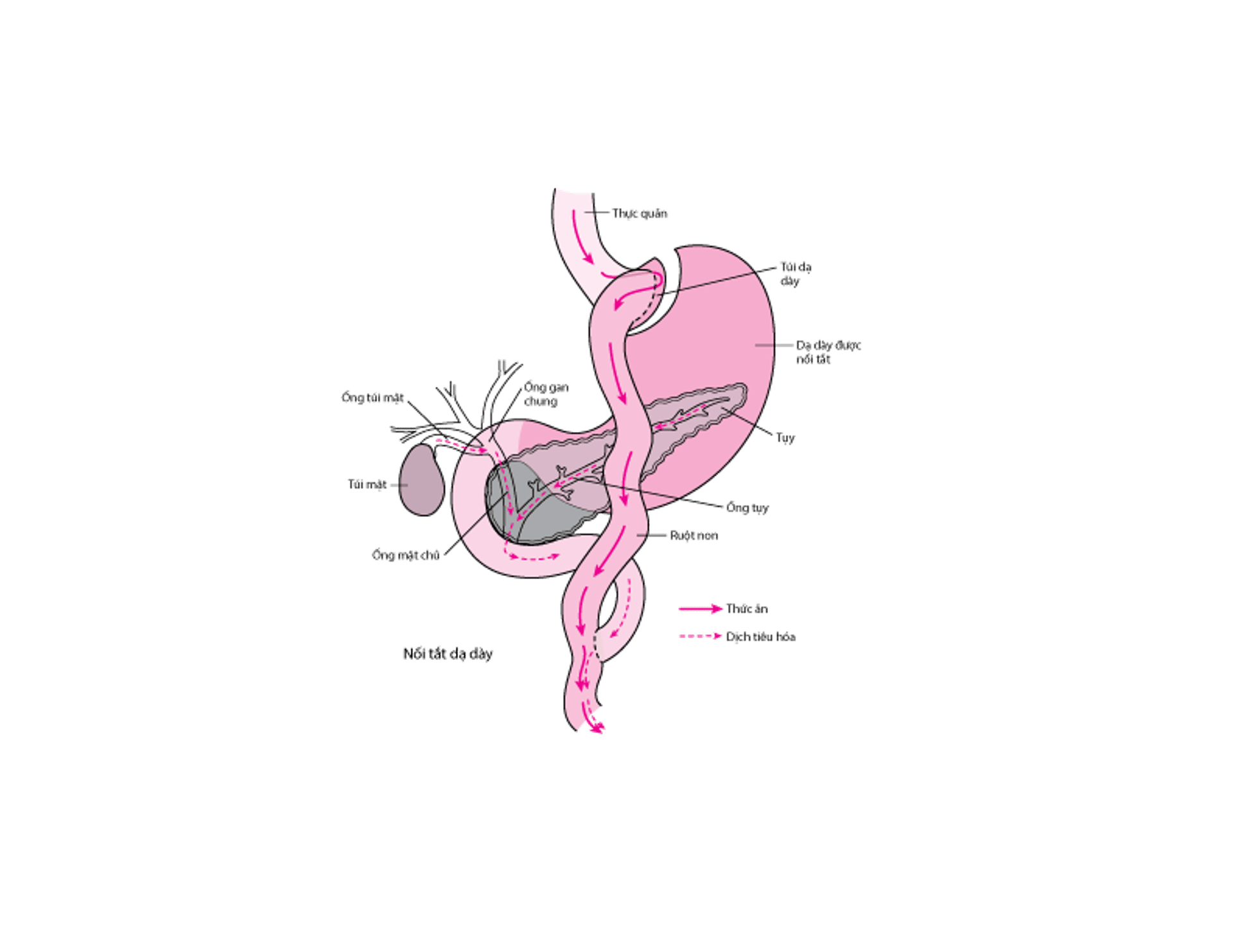 Phẫu thuật nối tắt dạ dày kiểu Roux-en-Y