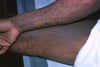 Atopic Dermatitis (Chronic)