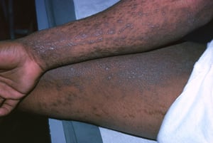 Atopische Dermatitis (Chronisch)
