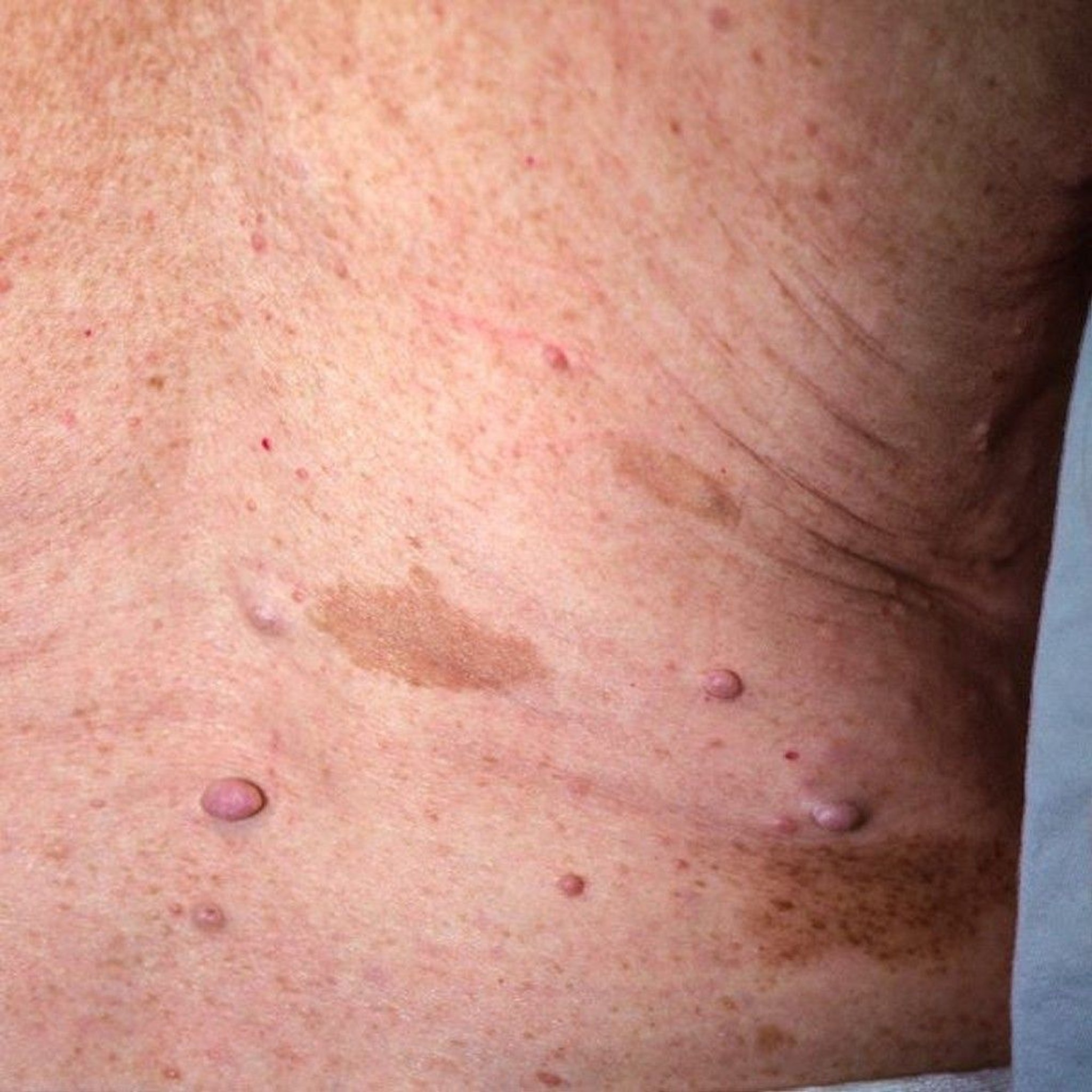 神経線維腫とカフェオレ斑