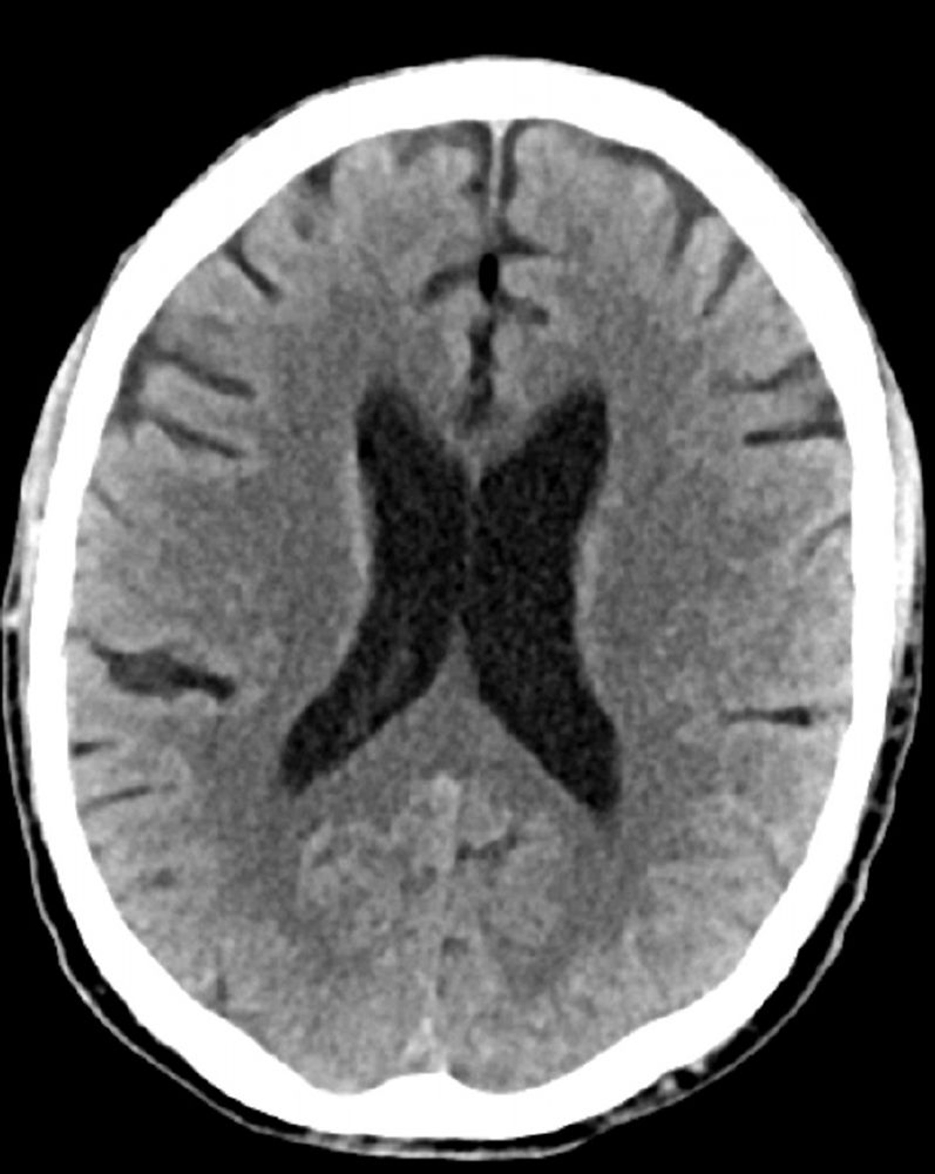 Normaler Kopf CT-Scan (Erwachsene, Alter 74) – Folie 4