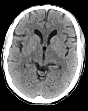 Normaler Kopf CT-Scan (Erwachsene, Alter 74) – Folie 6