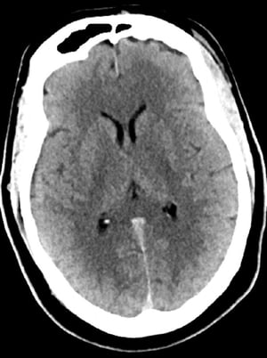 Normaler Kopf CT-Scan (Erwachsene, Alter 30) – Folie 5