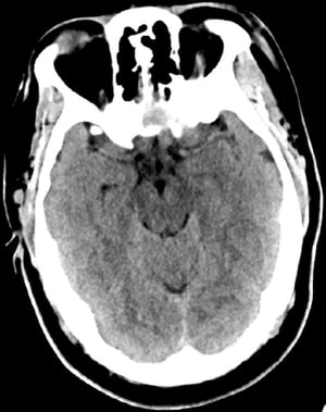 Normaler Kopf CT-Scan (Erwachsene, Alter 30) – Folie 6