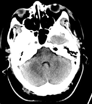 Normaler Kopf-CT-Scan (Erwachsener, Alter 30) - Folie 7