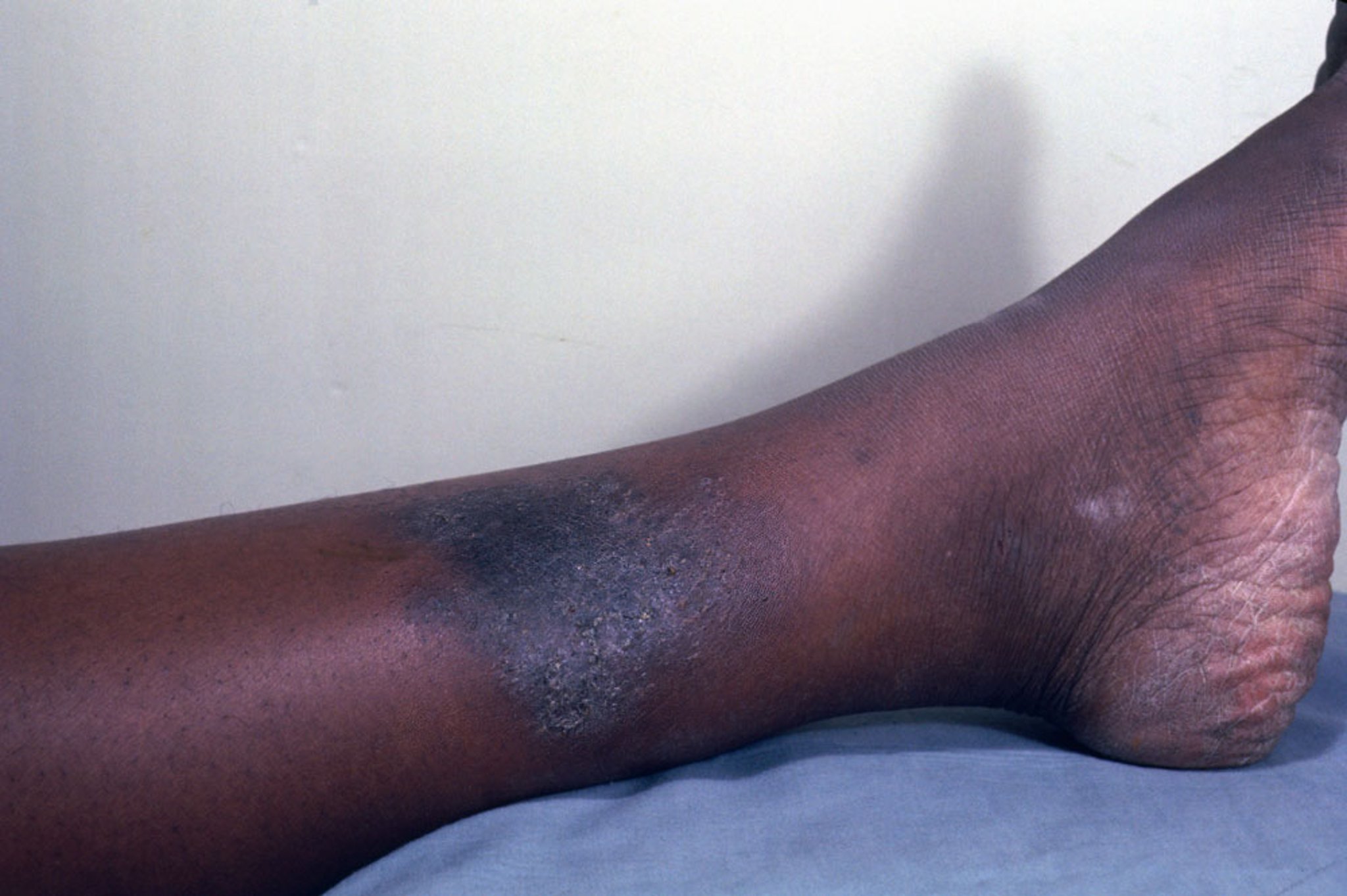 Nummular Dermatitis (2)