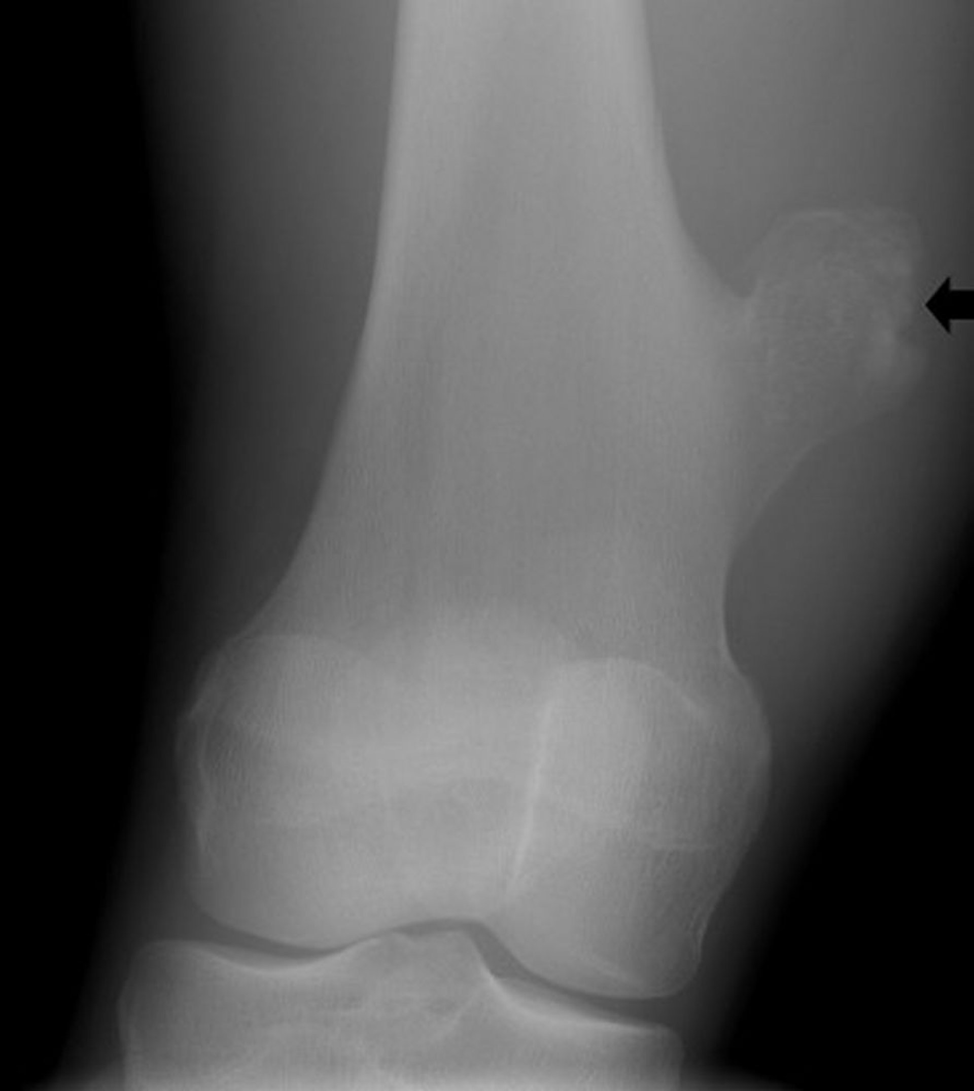 Osteochondrom des Knies