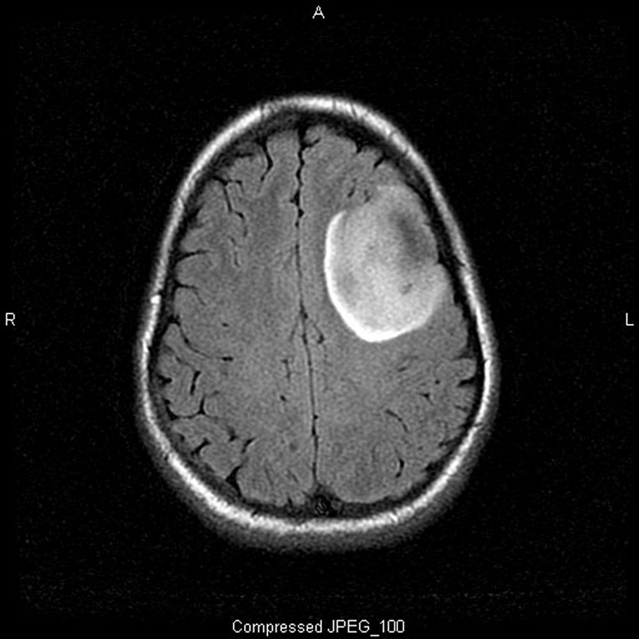 Oligodendroglioma de bajo grado