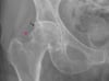 Osteoarthritis of the Hip