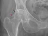Osteoarthritis der Hüfte