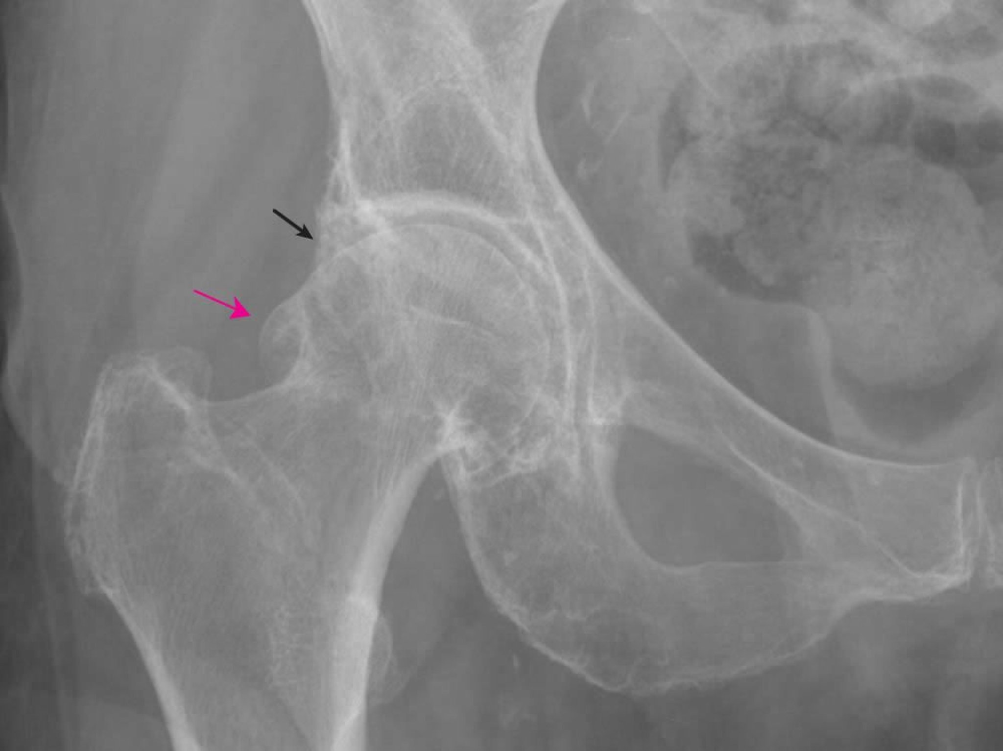 Arthrose de la hanche